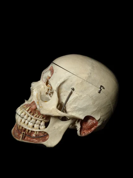 Human Skull With Metopic Suture