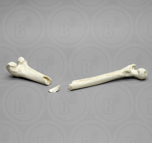 Human Female, Blunt Force Trauma - Femur 3 Pcs