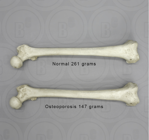 Human Adult Female Femur, Osteoporosis Comparative Set